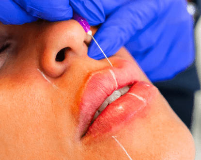 <p style="font-family: 'Poppins', sans-serif; font-weight: 700; font-size:24px;">LIP LIFT</p>